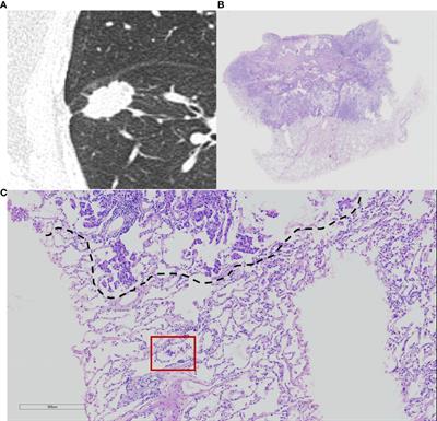 Clinicopathological and CT features of tumor spread through air space in invasive lung adenocarcinoma